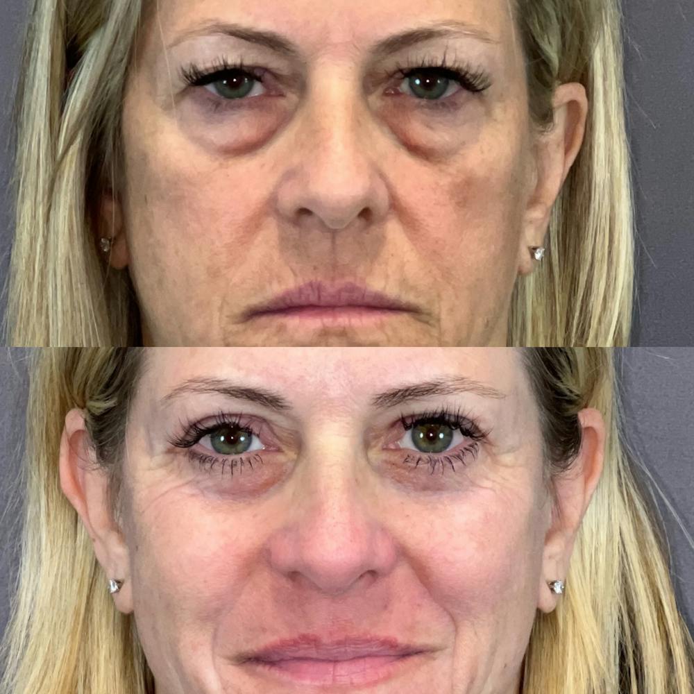 Lower Blepharoplasty Before & After Gallery - Patient 145833616 - Image 1