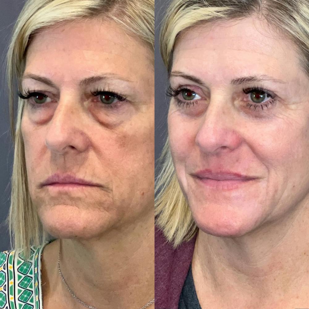 Laser Resurfacing Before & After Gallery - Patient 145833618 - Image 3