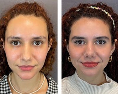 Rhinoplasty Before & After Gallery - Patient 146248254 - Image 1