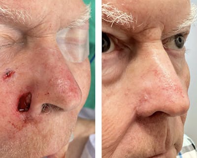 Mohs Reconstruction  Before & After Gallery - Patient 146248468 - Image 1