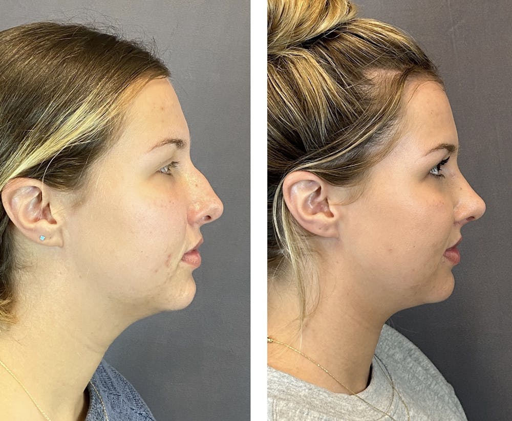 Patient 146248582 Rhinoplasty Before & After Photos Austin Face & Body