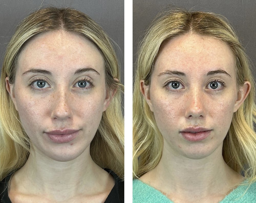 Rhinoplasty Before & After Gallery - Patient 146248589 - Image 1
