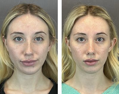 Rhinoplasty Before & After Gallery - Patient 146248589 - Image 1