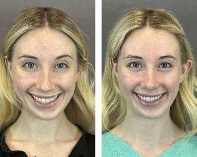 Rhinoplasty Before & After Gallery - Patient 146248589 - Image 2