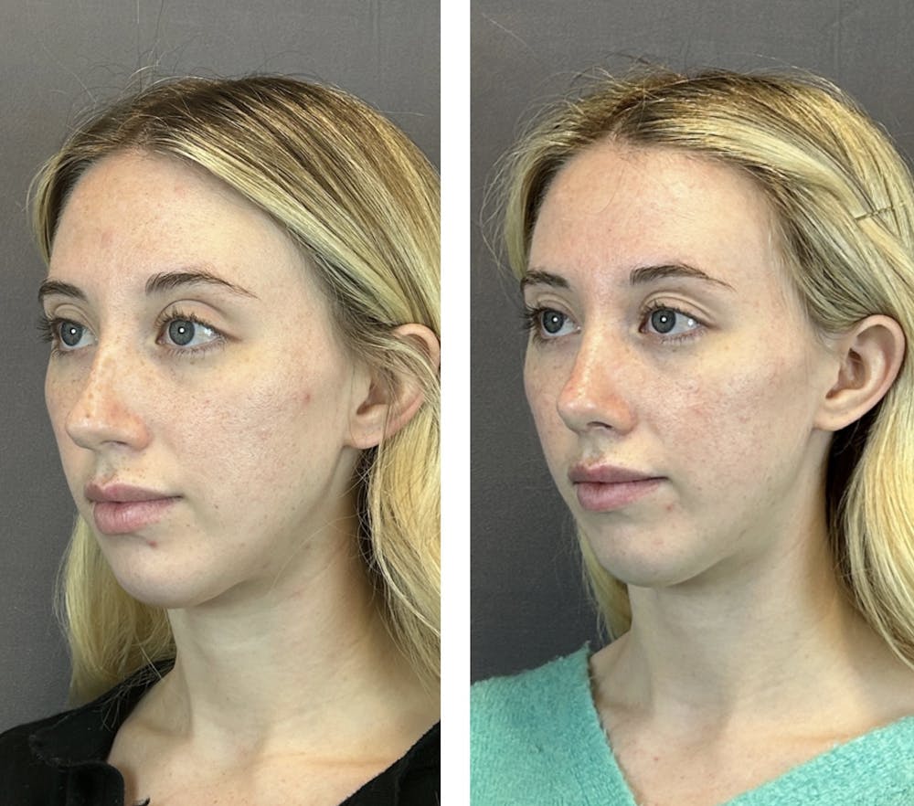 Rhinoplasty Before & After Gallery - Patient 146248589 - Image 3