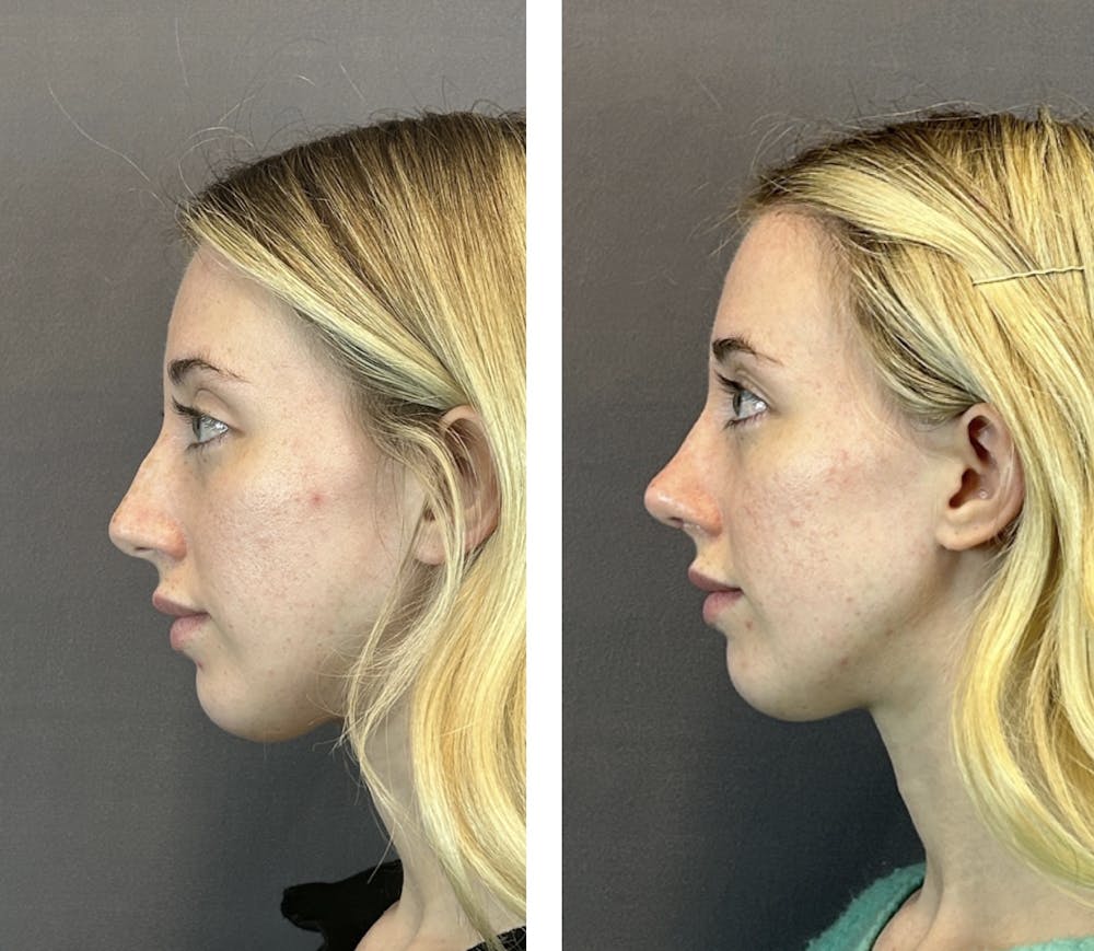 Rhinoplasty Before & After Gallery - Patient 146248589 - Image 4