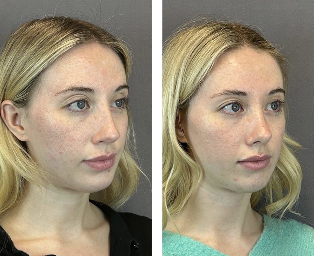 Rhinoplasty Before & After Gallery - Patient 146248589 - Image 5