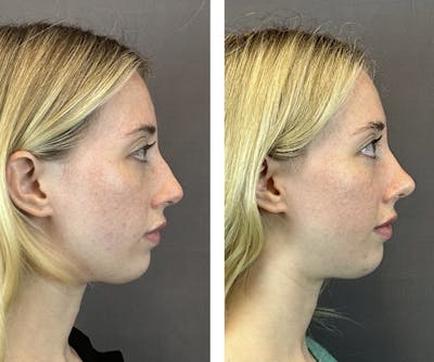 Rhinoplasty Before & After Gallery - Patient 146248589 - Image 6