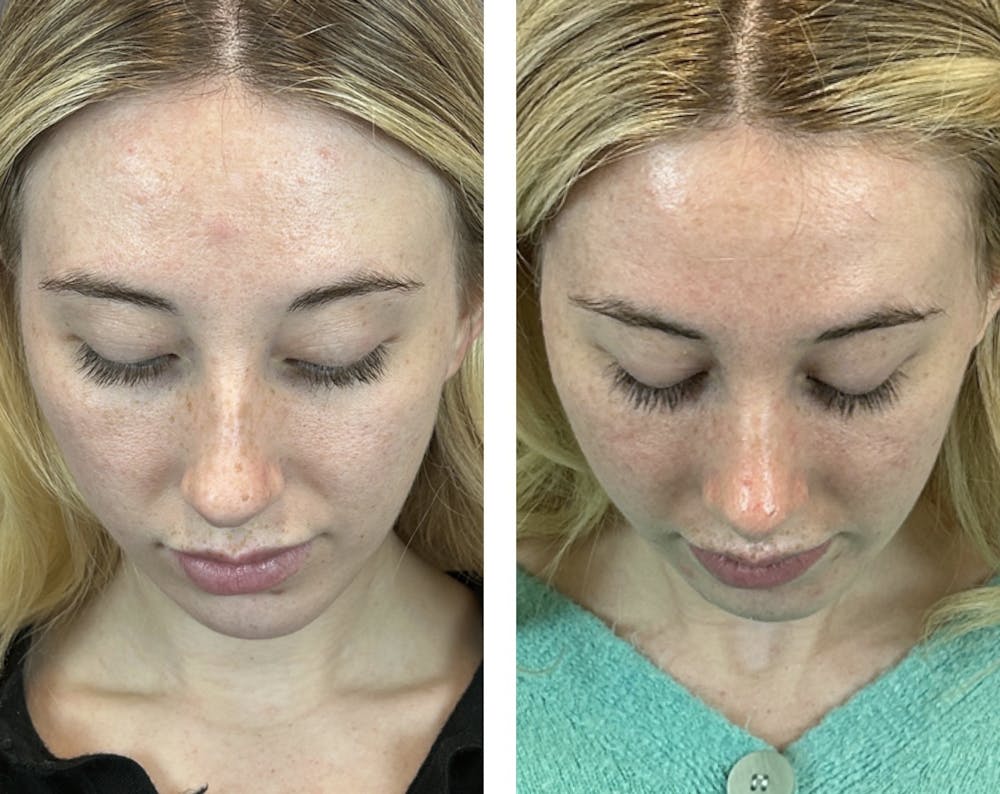 Rhinoplasty Before & After Gallery - Patient 146248589 - Image 7