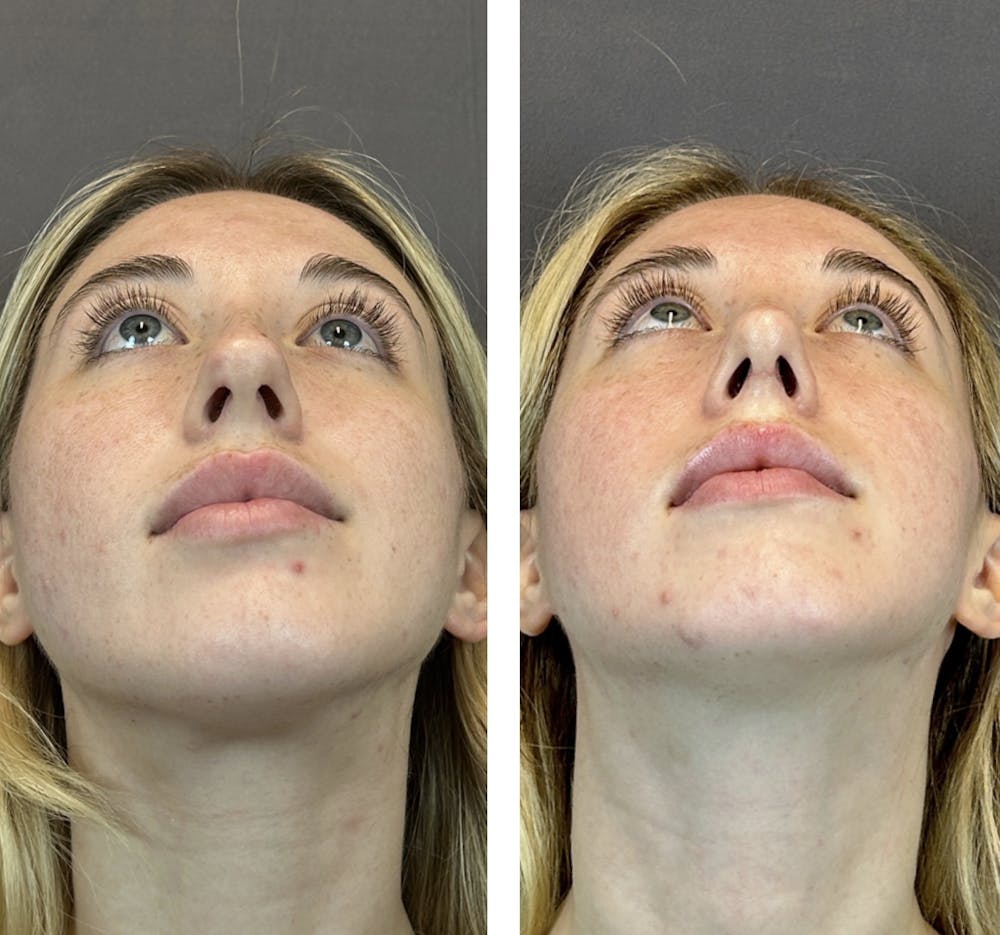 Rhinoplasty Before & After Gallery - Patient 146248589 - Image 8