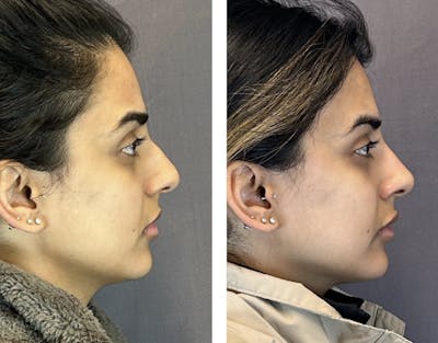Non-Surgical Rhinoplasty Before & After Gallery - Patient 107747 - Image 1