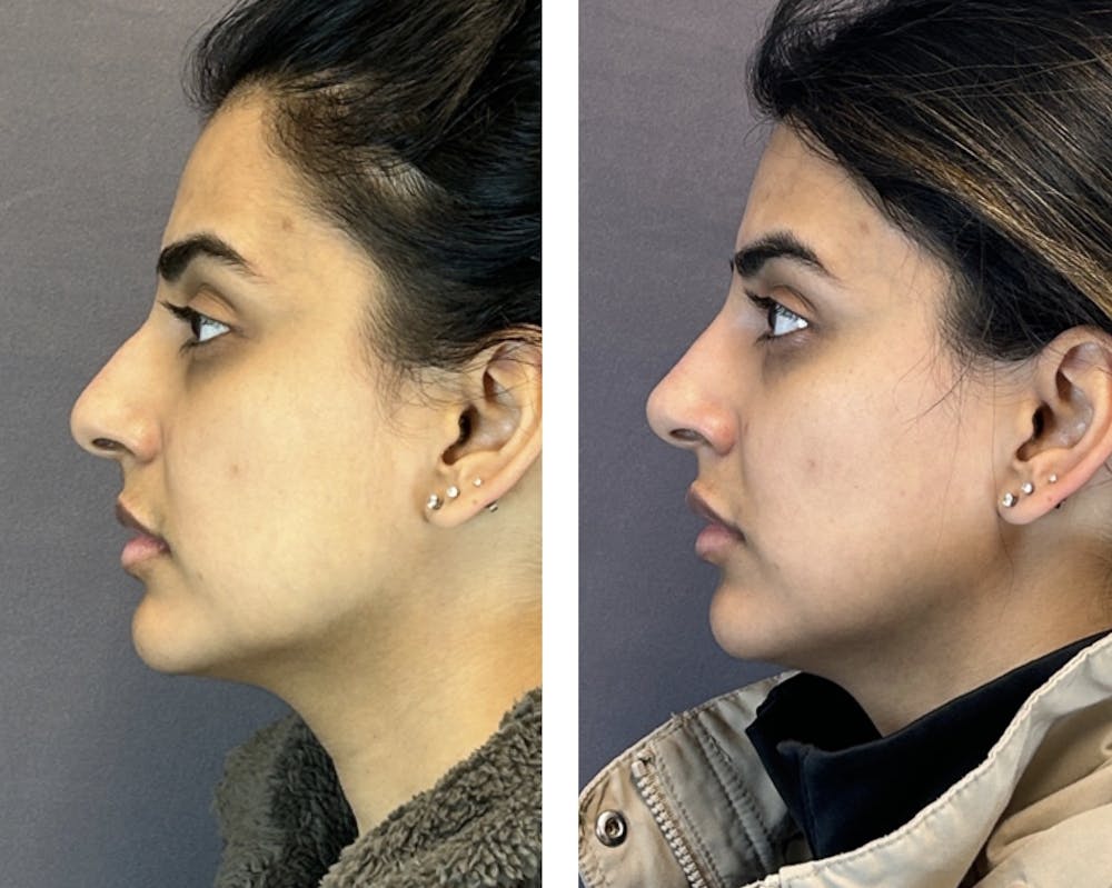 Non-Surgical Rhinoplasty Before & After Gallery - Patient 107747 - Image 2
