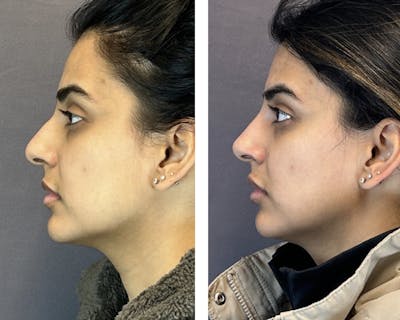 Non-Surgical Rhinoplasty Before & After Gallery - Patient 146287087 - Image 2