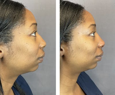 Non-Surgical Rhinoplasty Before & After Gallery - Patient 224217 - Image 1
