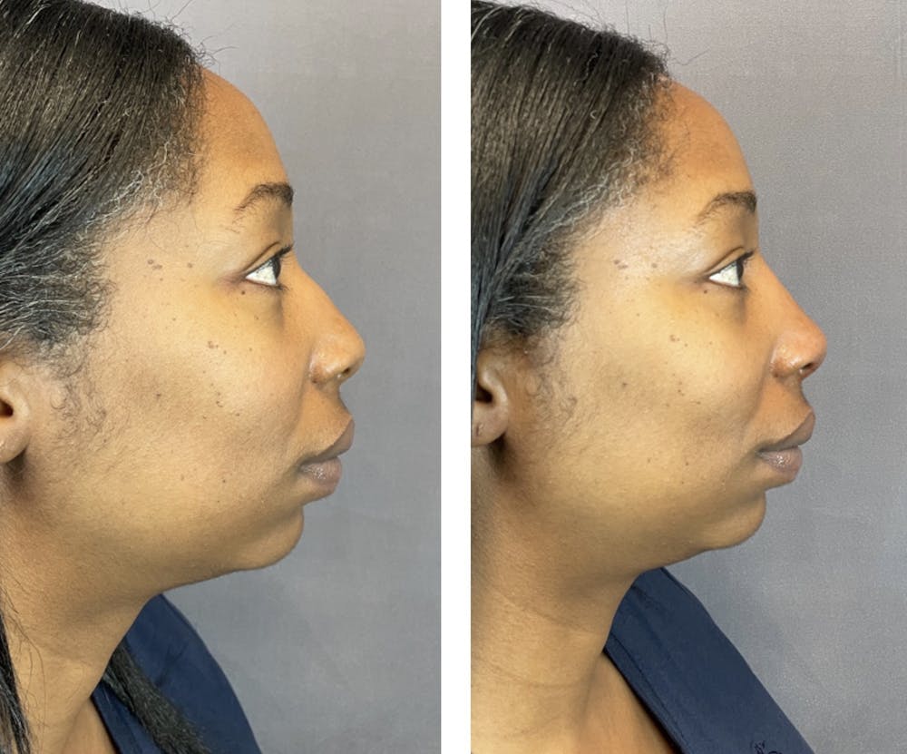 Non-Surgical Rhinoplasty Before & After Gallery - Patient 146287086 - Image 1
