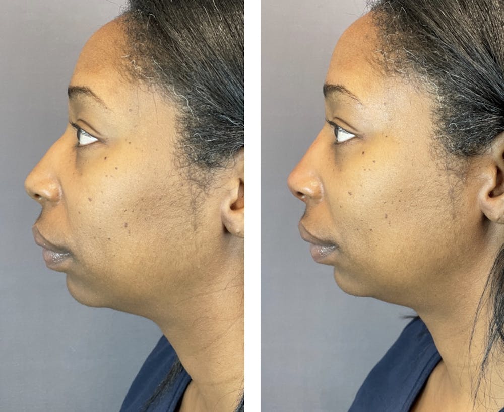 Non-Surgical Rhinoplasty Before & After Gallery - Patient 146287086 - Image 2
