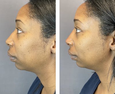 Non-Surgical Rhinoplasty Before & After Gallery - Patient 224217 - Image 2