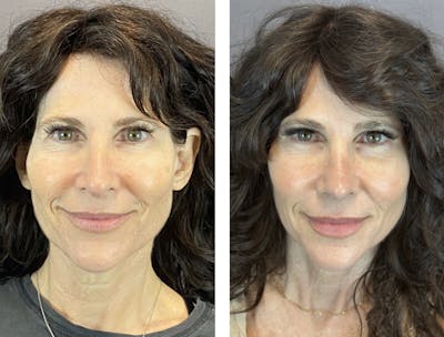 Rhinoplasty Before & After Gallery - Patient 146287093 - Image 2