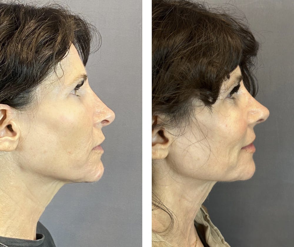 Rhinoplasty Before & After Gallery - Patient 146287093 - Image 1