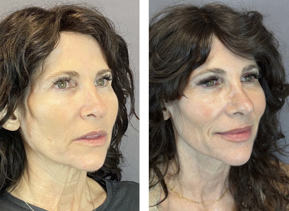 Rhinoplasty Before & After Gallery - Patient 146287093 - Image 3