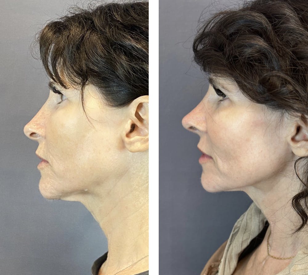 Rhinoplasty Before & After Gallery - Patient 146287093 - Image 5