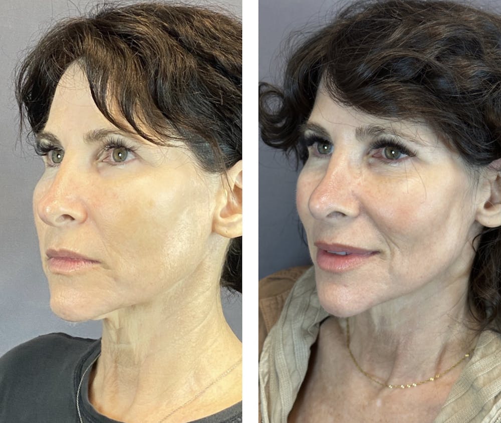 Rhinoplasty Before & After Gallery - Patient 146287093 - Image 4