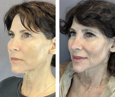 Rhinoplasty Before & After Gallery - Patient 146287093 - Image 4