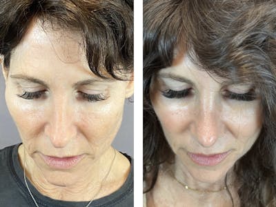 Rhinoplasty Before & After Gallery - Patient 146287093 - Image 6