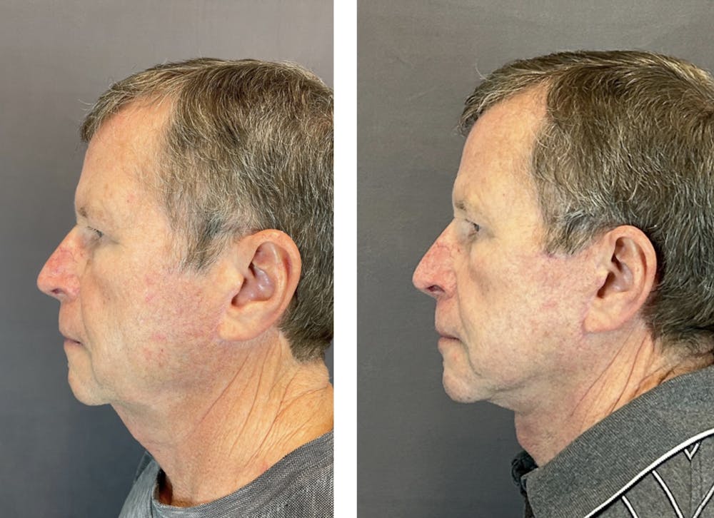 Facelift Before & After Gallery - Patient 146342670 - Image 2