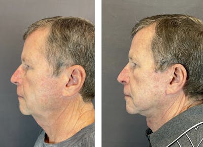 Facelift Before & After Gallery - Patient 146342670 - Image 1