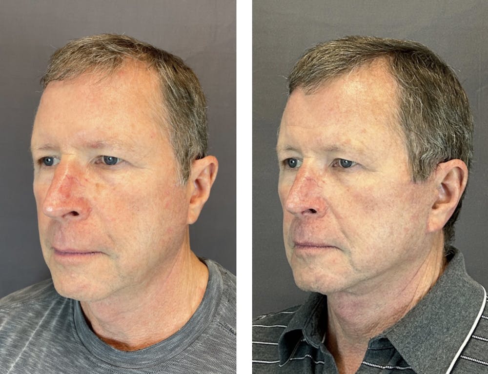 Facelift Before & After Gallery - Patient 146342670 - Image 3