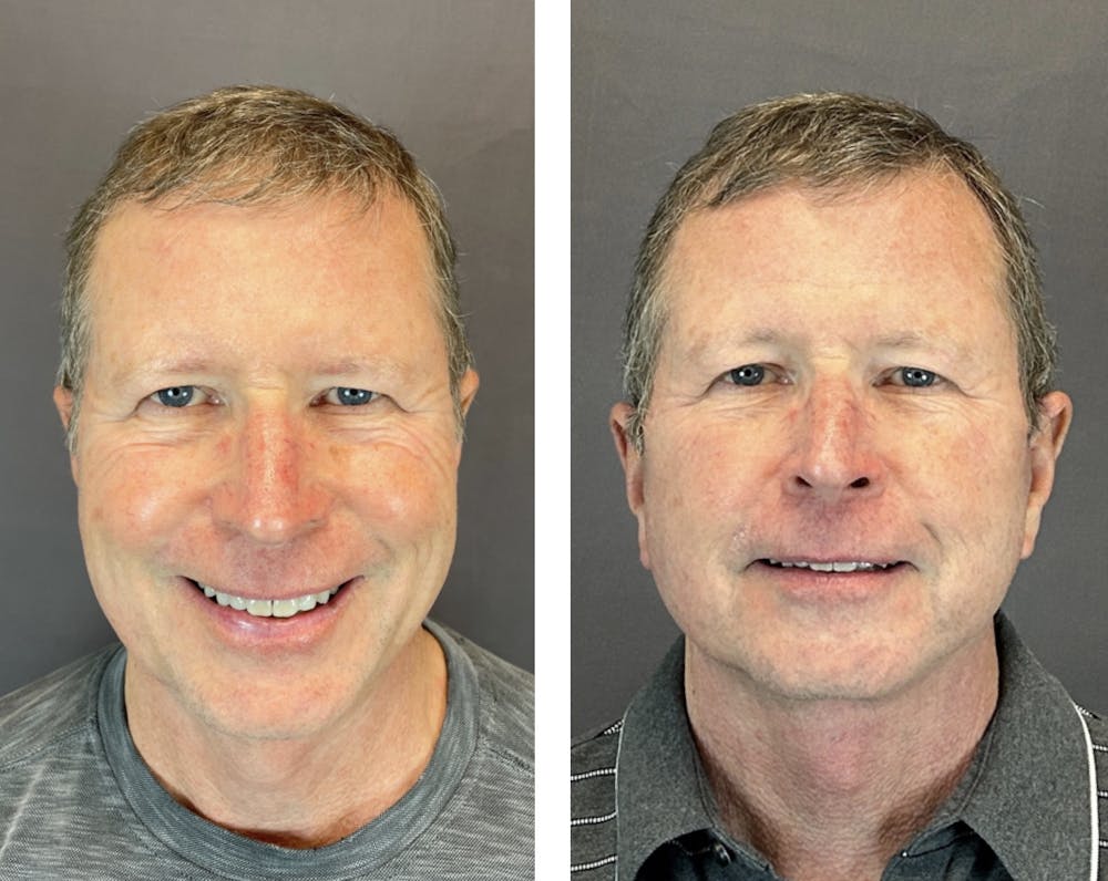 Facelift Before & After Gallery - Patient 146342670 - Image 1