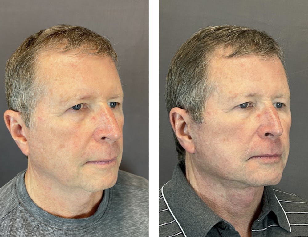 Facelift Before & After Gallery - Patient 146342670 - Image 4