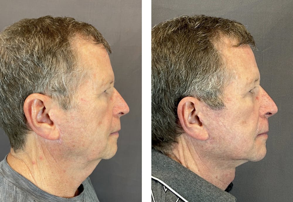Facelift Before & After Gallery - Patient 146342670 - Image 5