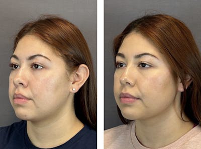 Dermal Fillers Before & After Gallery - Patient 146342691 - Image 1