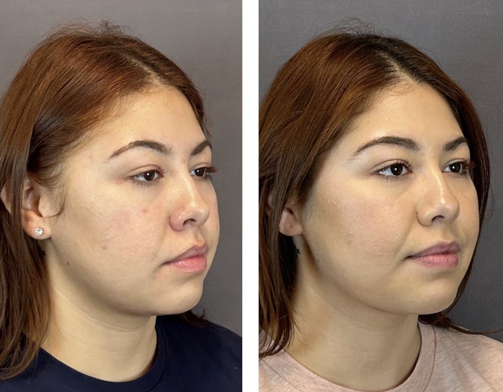 Dermal Fillers Before & After Gallery - Patient 146342691 - Image 2
