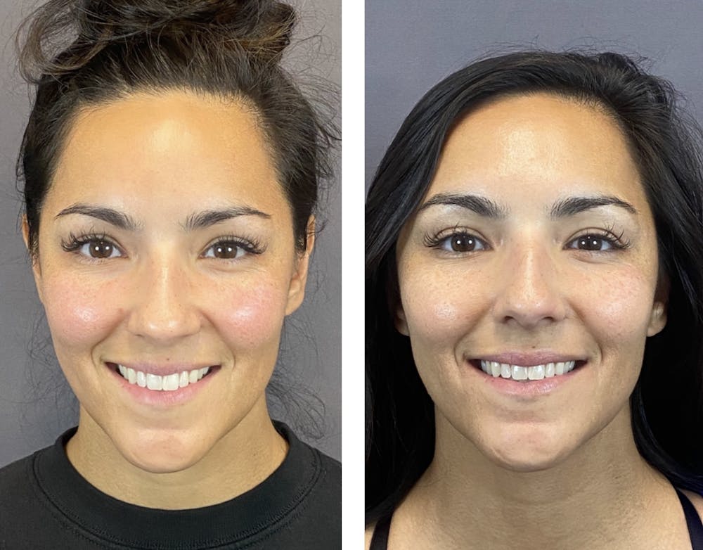 BOTOX Before & After Gallery - Patient 146342696 - Image 1