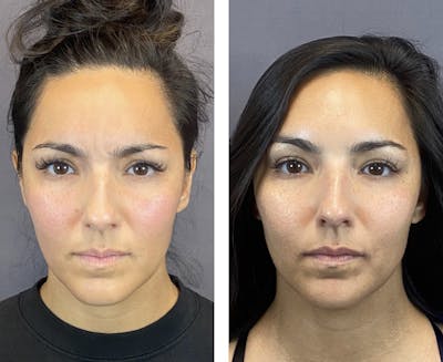 BOTOX Before & After Gallery - Patient 146342696 - Image 2