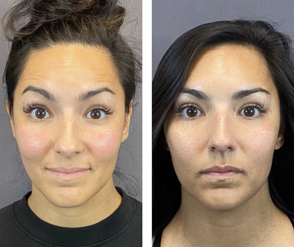 BOTOX Before & After Gallery - Patient 146342696 - Image 3