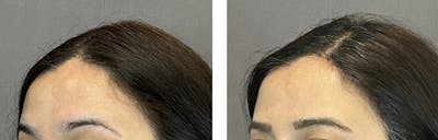 Lipoma Removal Before & After Gallery - Patient 146342718 - Image 1