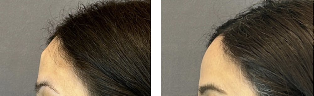 Lipoma Removal Before & After Gallery - Patient 146342718 - Image 2