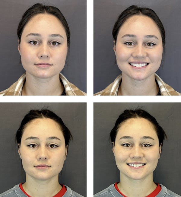 Buccal Fat Reduction Before & After Gallery - Patient 146342722 - Image 1