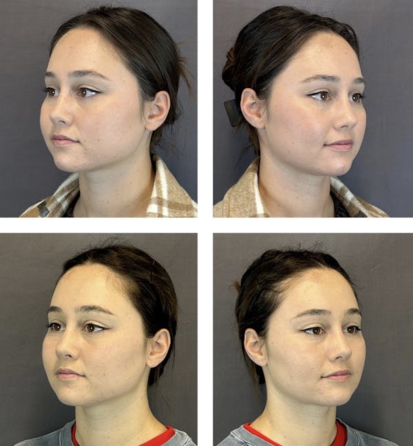 Buccal Fat Reduction Before & After Gallery - Patient 146342722 - Image 2