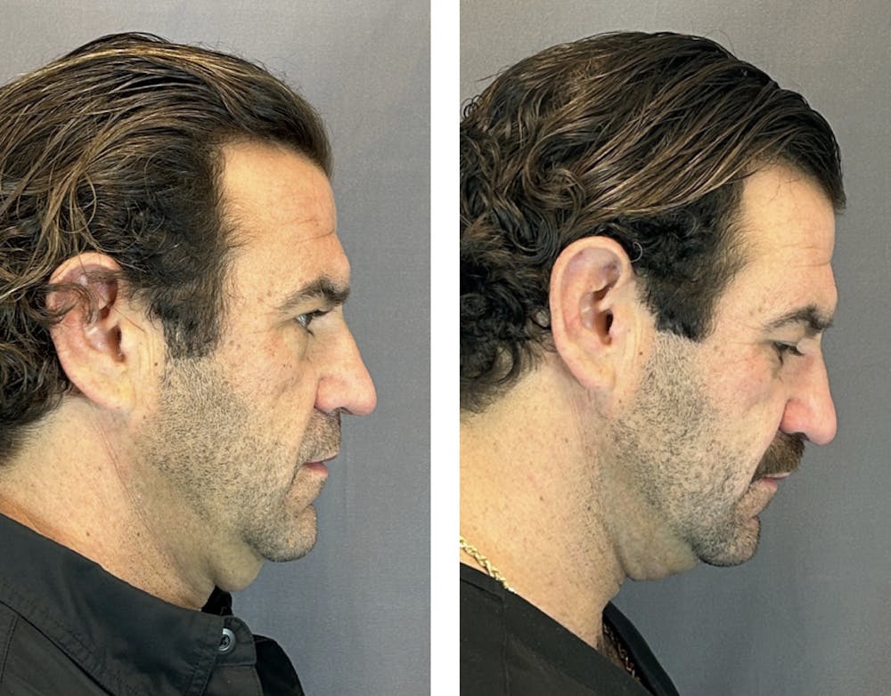 Facetite Before & After Gallery - Patient 146342788 - Image 3