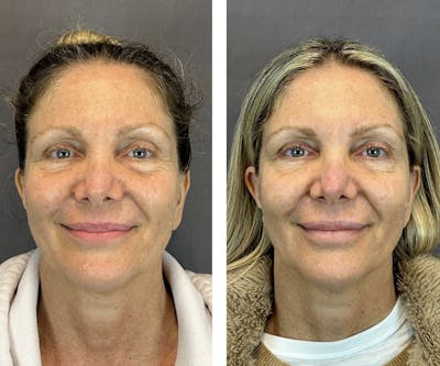 Dermal Fillers Before & After Gallery - Patient 146416181 - Image 1
