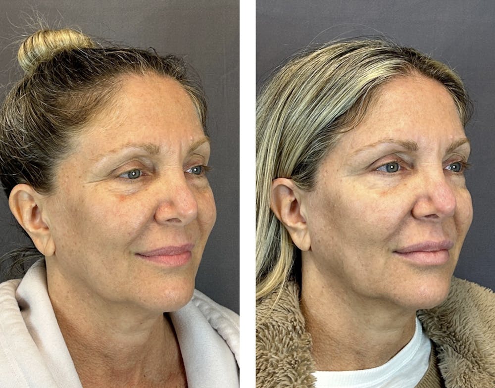 Dermal Fillers Before & After Gallery - Patient 146416181 - Image 2