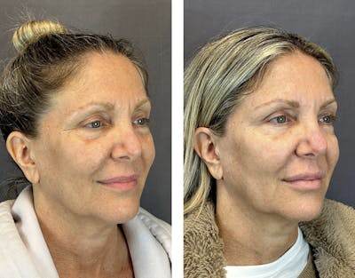 Lip Fillers Before & After Gallery - Patient 146416193 - Image 2