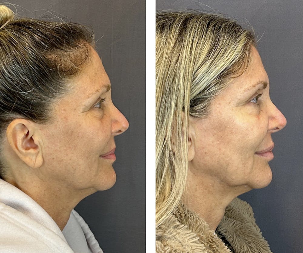 Lip Fillers Before & After Gallery - Patient 146416193 - Image 3