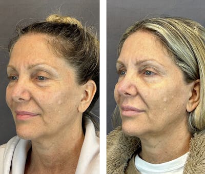 Dermal Fillers Before & After Gallery - Patient 146416181 - Image 4