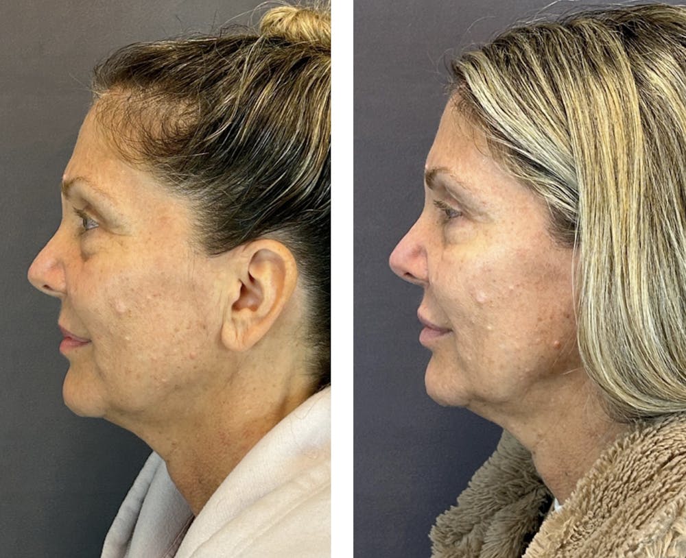 BOTOX Before & After Gallery - Patient 146416182 - Image 5